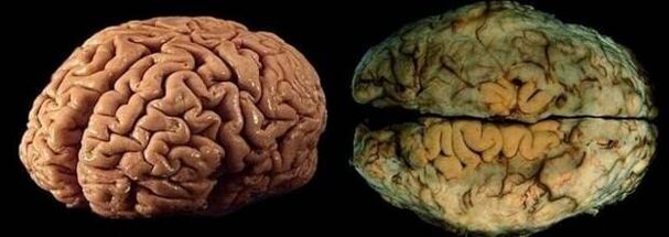 sveiko ir geriančio žmogaus smegenis